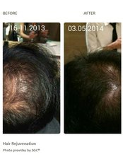 Hair Loss Treatment - LIFE Clinic
