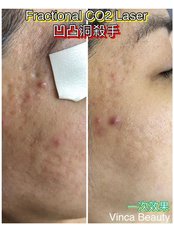 Fractional CO2 Laser Treatment - Lily Medi Spa