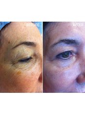 Acne Scars Treatment - Selin Laser MedSpa