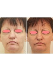 Soft Silhouette face lift absorbable fibers - Boulevard Medical Centre Budapest