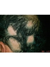 Bald Spot Removal - Kayakalph