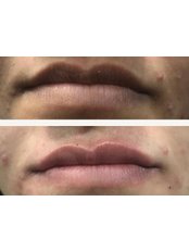 Lip Filler - GD Aesthetic Clinic