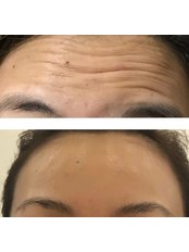 Treatment for Wrinkles - GD Aesthetic Clinic