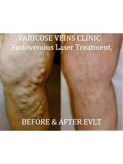Varicose Veins Laser Treatment - Varicose Veins Clinic