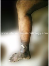 Ulcer Healed after Laser Treatment - Varicose Veins Laser Clinic