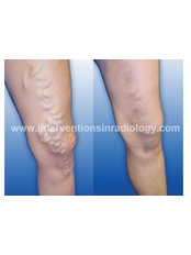 Before and After Laser Treatment - Varicose Veins Laser Clinic