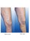 Varicose Veins Laser Clinic - The Pain Free Day Care Laser Procedure with good results 