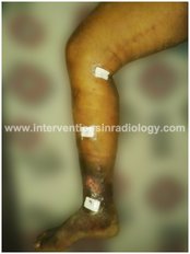 Before going for Laser Treatment - Varicose Veins Laser Clinic