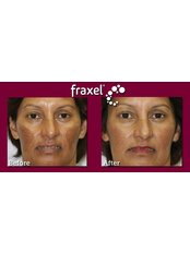 Fraxel™ - Atelier Cosmetic Plastic and Laser Clinic-N Dehli