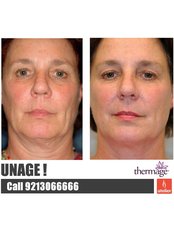 Thermage™ - Atelier Cosmetic Plastic and Laser Clinic-N Dehli