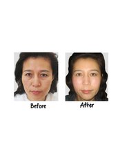Pigmentation Treatment - Victory BLC Therapy - Bali