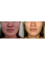 Skin Revitalisation - Victory BLC Therapy - Bali