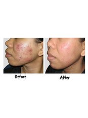 Acne Treatment - Victory BLC Therapy - Bali