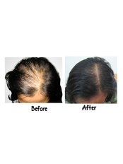 Treatment for Female Pattern Hair Loss - Victory BLC Therapy - Bali