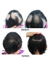Bald Spot Removal - Victory BLC Therapy - Bali