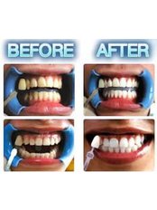 Teeth Whitening - Laserderm Clinic - Ennis