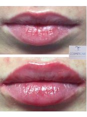 Lip Enhancement - Anne Hegarty, Cosmeticare