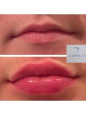 Lip Enhancement - Anne Hegarty, Cosmeticare