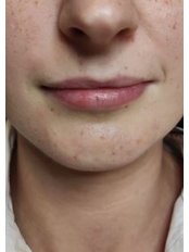 Lip Augmentation - Dr.Juan Corado Aesthetic Clinic