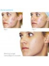 Acne Treatment - Kathryn Revell Cosmetic