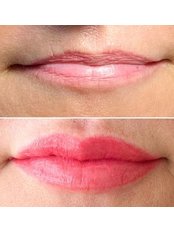 Lip Augmentation - La Lueur
