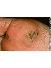 Wart Removal - Ailesbury Clinic