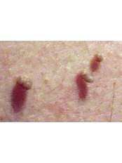 Skin Tag Removal - Ailesbury Clinic