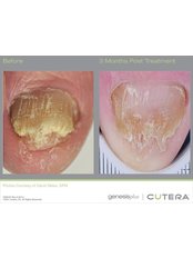 Toenail Fungus Treatment - Akina Laser and Beauty Clinic