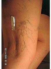 Spider Veins Treatment - Akina Laser and Beauty Clinic