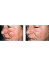 Rosacea skin  Consultation - Cosmetic Doctor Slievemore Clinic