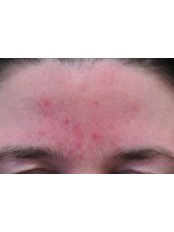 Rosacea skin  Consultation - Cosmetic Doctor Slievemore Clinic