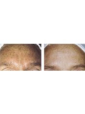 STRATCH MARKS AND SCARRING - Cosmetic Doctor Slievemore Clinic