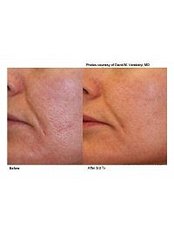 Laser Wrinkle Reduction - Akina Laser and Beauty Clinic