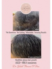 Hair Loss Treatment - LIKHA Aesthetic Clinic
