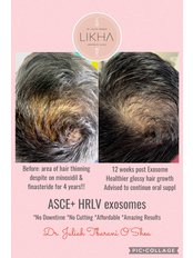 HRI - Hair Regrowth Injections - LIKHA Aesthetic Clinic