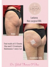 Non-surgical BBL - Brazilian Butt Lift - LIKHA Aesthetic Clinic
