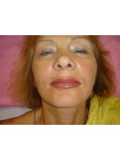 Lip Augmentation - His &Hers Micropigmentation Clinic