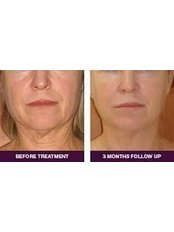 Radiofrequency Skin Tightening - Revive Clinic