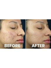 Chemical Peel - Lasersonix Face&Body Clinic