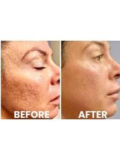 Microneedling - Lasersonix Face&Body Clinic