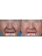 Skin Peel- Dermapeel - Lasersonix Face&Body Clinic