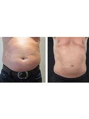 Fat Freezing - Lasersonix Face&Body Clinic
