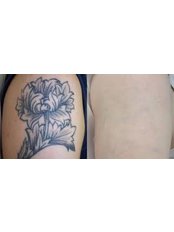 Tattoo Removal - Chezelle Skin and Laser Clinic