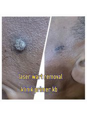 Skin Tag Removal - Klinik Primer Kota Bharu