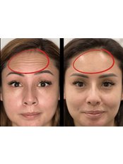 Treatment for Wrinkles - Regalion Clinic