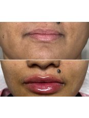 Lip Augmentation - Regalion Clinic