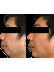 Chin Augmentation - Regalion Clinic