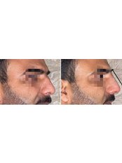 Non-Surgical Nose Job - Regalion Clinic