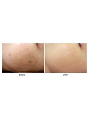 Age Spots Removal - SkinArt Group