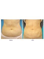 Fat Reduction Injections - SkinArt Group